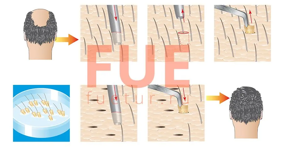 Безшовна пересадка волосся