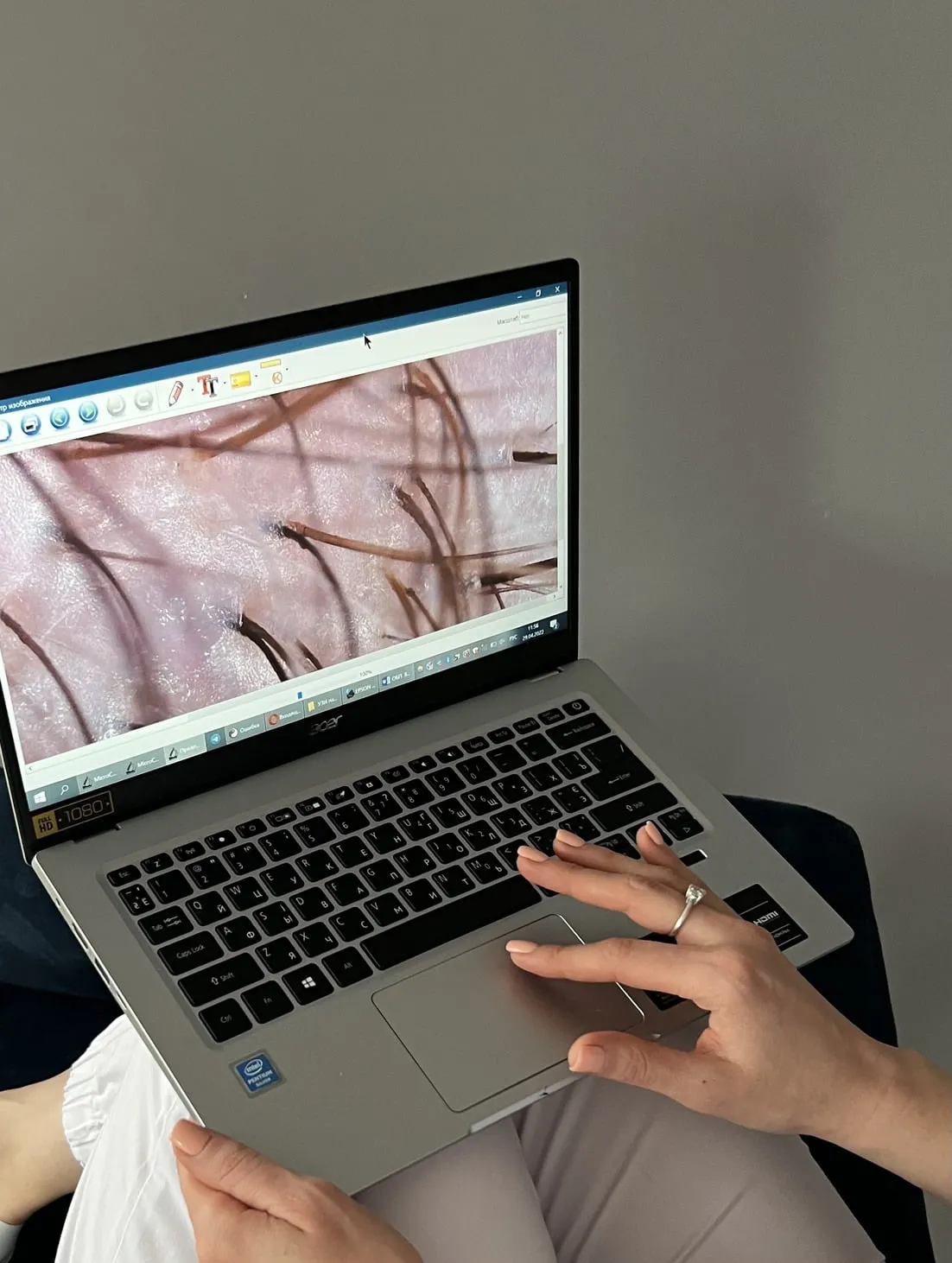 Трихоскопія